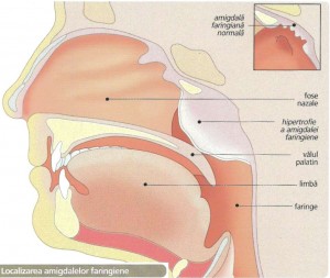 Vegetatiile adenoide sau polipii
